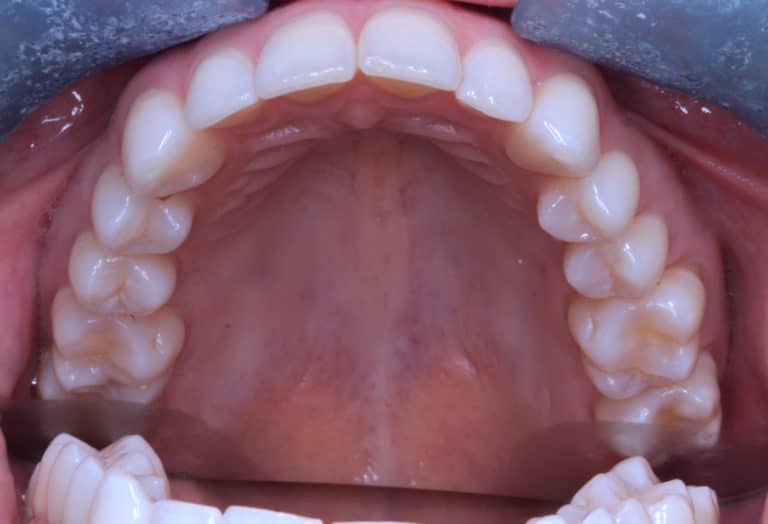Maxillary and mandibular crowding correction