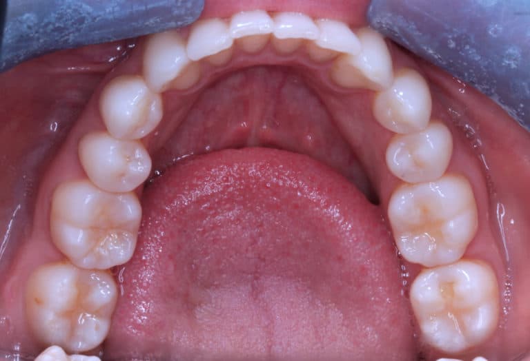 Maxillary and mandibular crowding correction