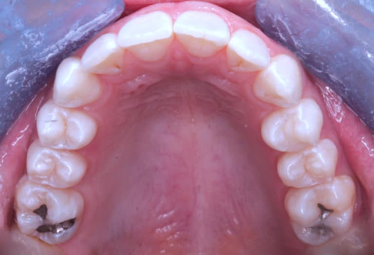 Maxillary teeth rounded into arch form- crowding correction