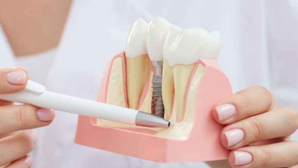 Dentist Explaining Tooth Implantation Process