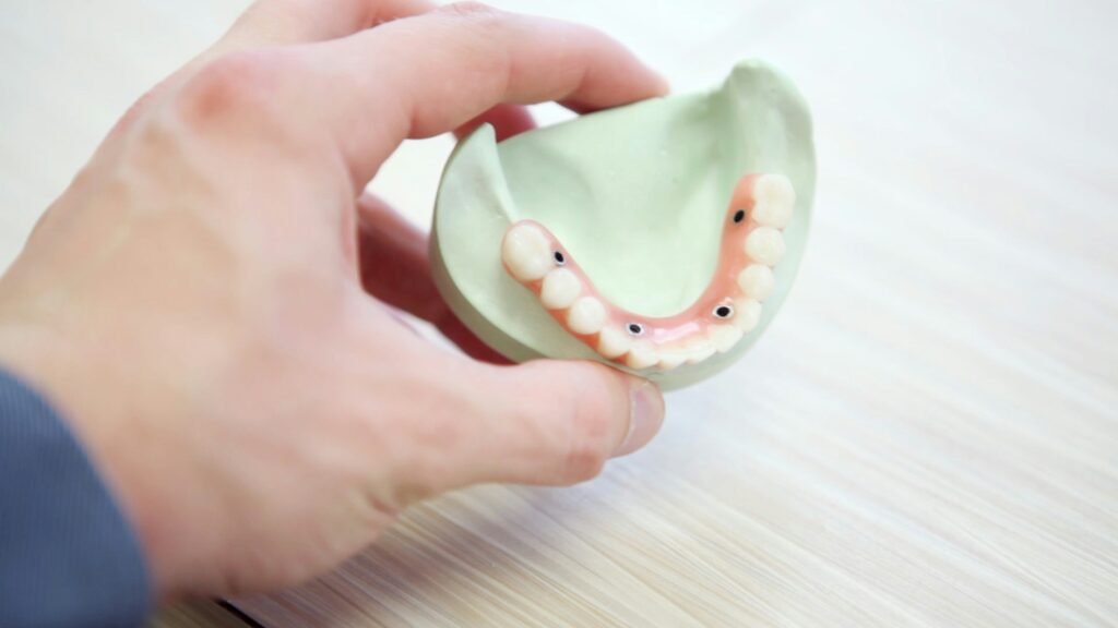 Dental bridges secured by implants.