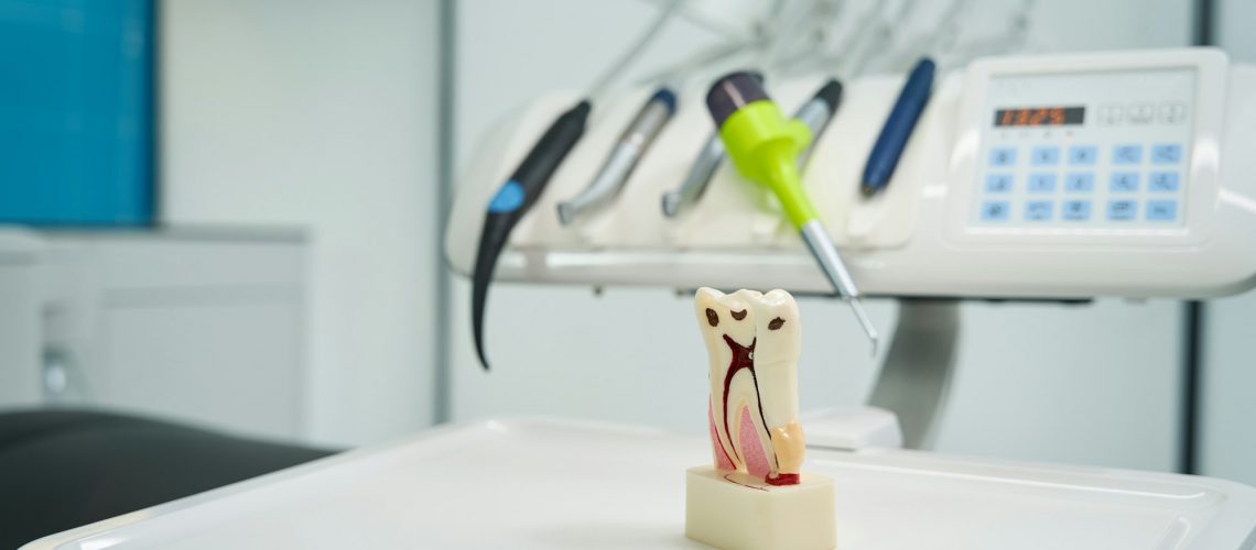 Tooth model displaying root canals and caries, illustrating dental decay and endodontic treatment for Wells Family Dental Group's Root Canal Awareness blog