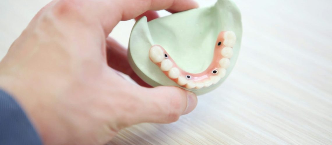 Dental bridges secured by implants.