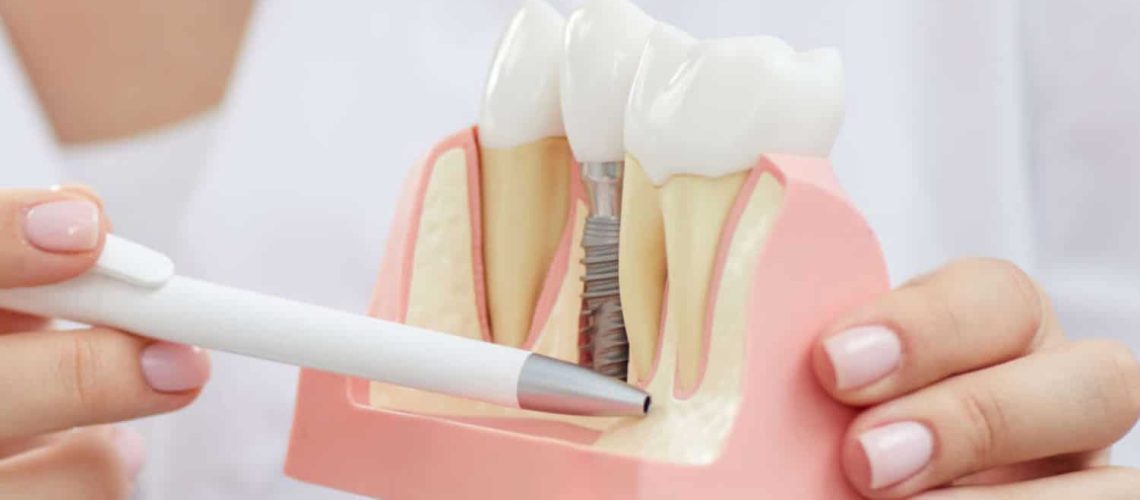 Dentist Explaining Tooth Implantation Process